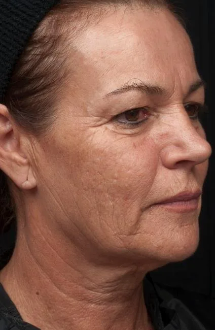 Thermage Face — after