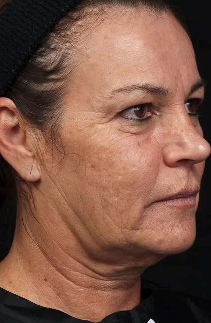 Thermage Face — before