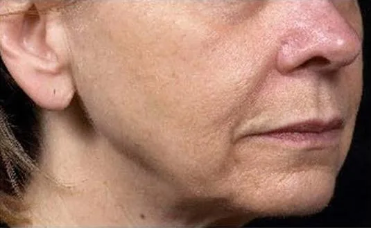 Thermage Jawline & neck — after