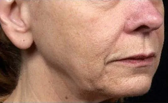 Thermage Jawline & neck — before