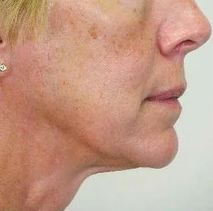 Thermage Jawline & neck — after