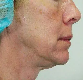 Thermage Jawline & neck — before