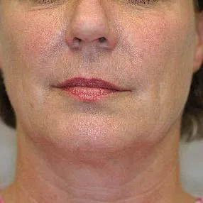 Thermage Neck — after