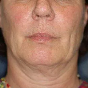 Thermage Neck — before