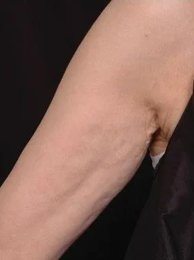 Thermage Jawline & neck — after