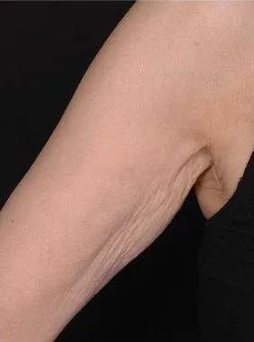 Thermage Jawline & neck — before