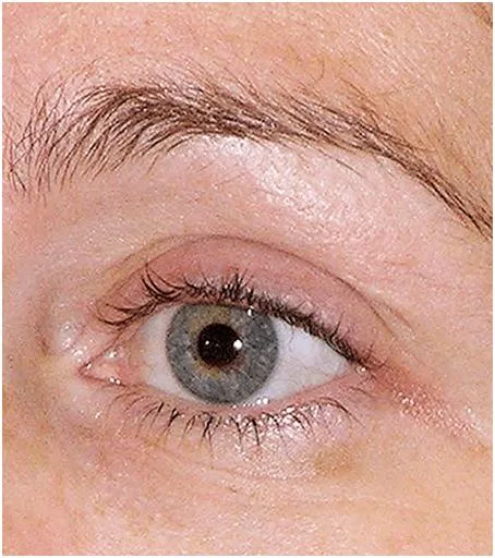Thermage Eye area — after