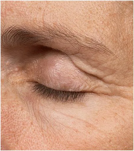 Thermage Eye area — before