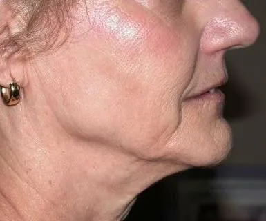 Thermage Face — after