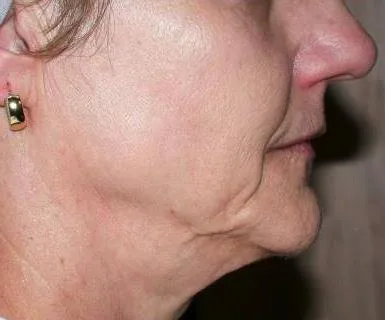 Thermage Face — before