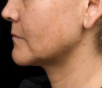 Thermage Neck — after