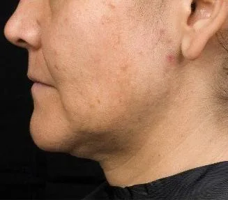 Thermage Neck — before