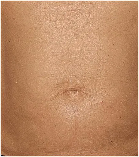 Thermage Body — after