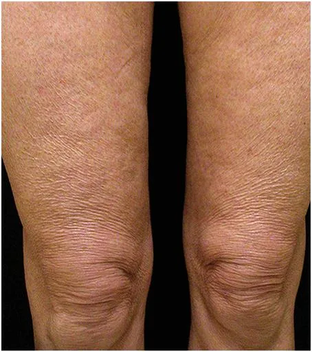 Thermage Body — before