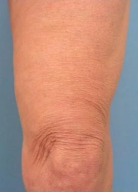 Thermage Body — after
