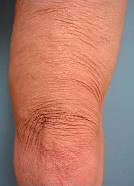 Thermage Body — before