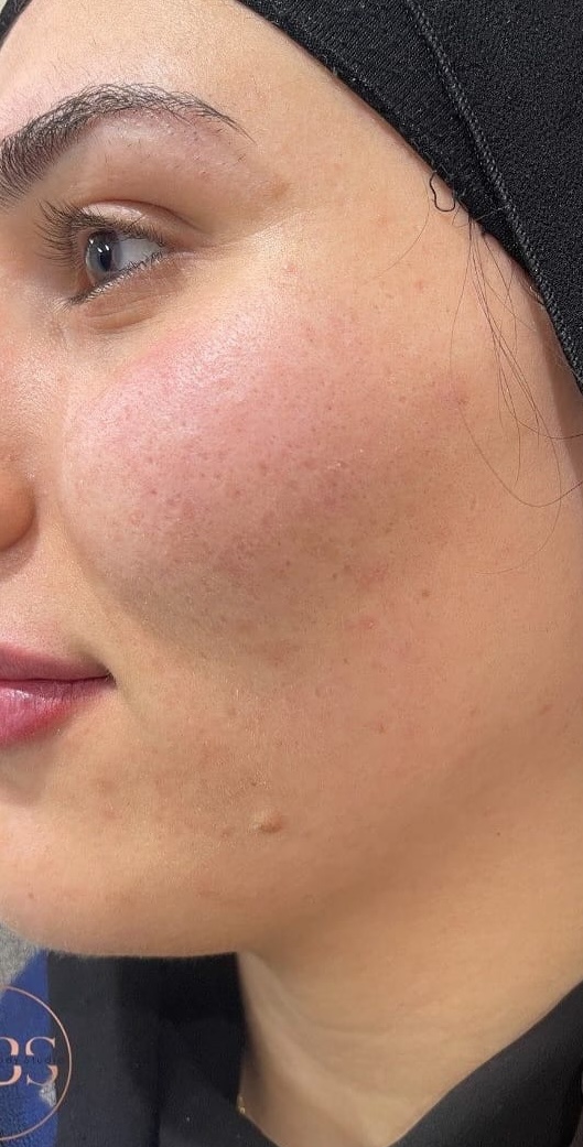 SQT Bio-Microneedling Face after treatment