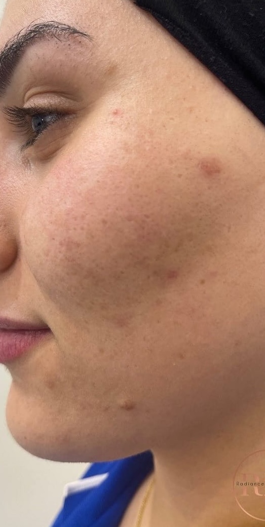 SQT Bio-Microneedling Face before treatment