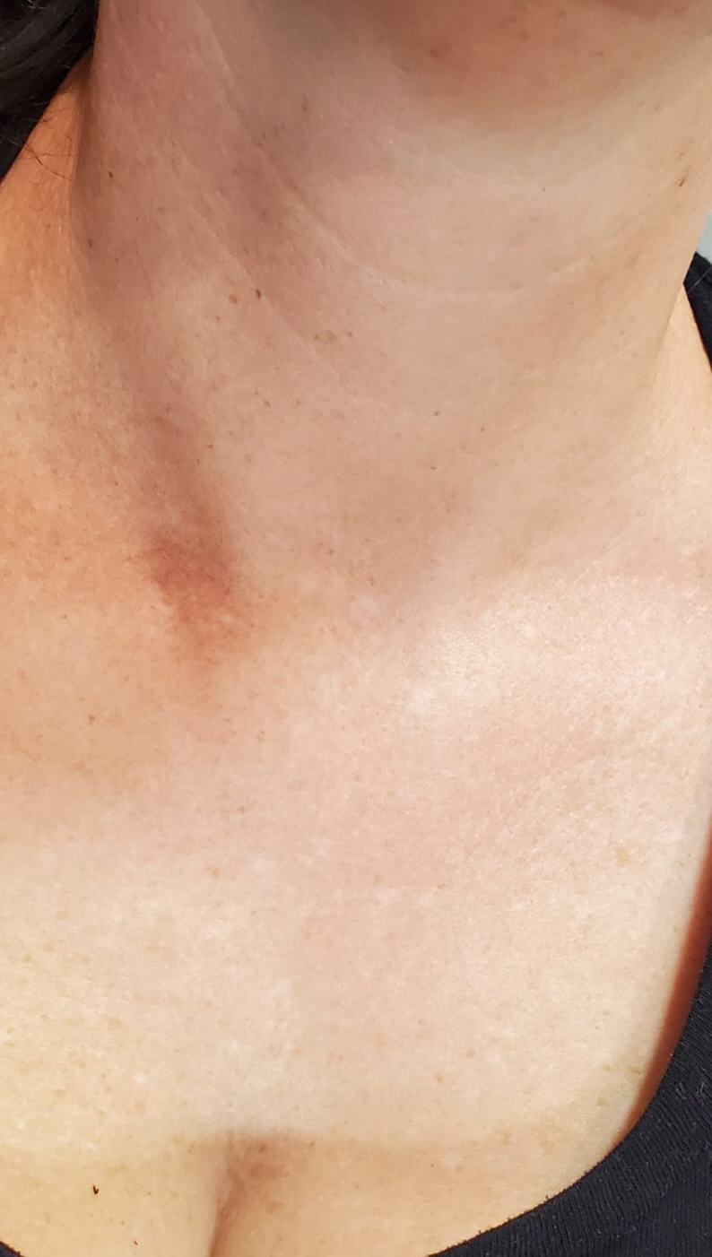 SQT Bio-Microneedling Body after treatment