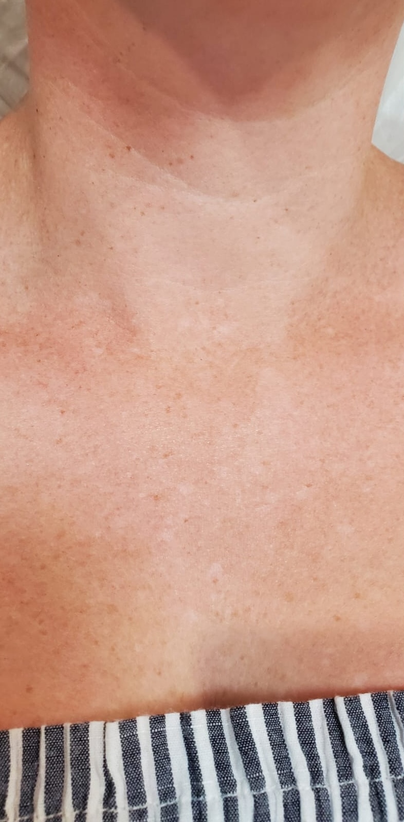 SQT Bio-Microneedling Body before treatment
