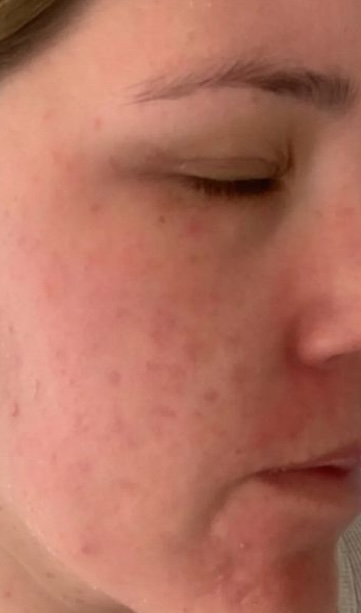 SQT Bio-Microneedling Face after treatment