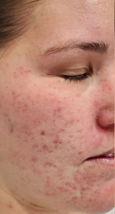 SQT Bio-Microneedling Face before treatment