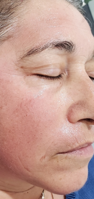SQT Bio-Microneedling Face after treatment