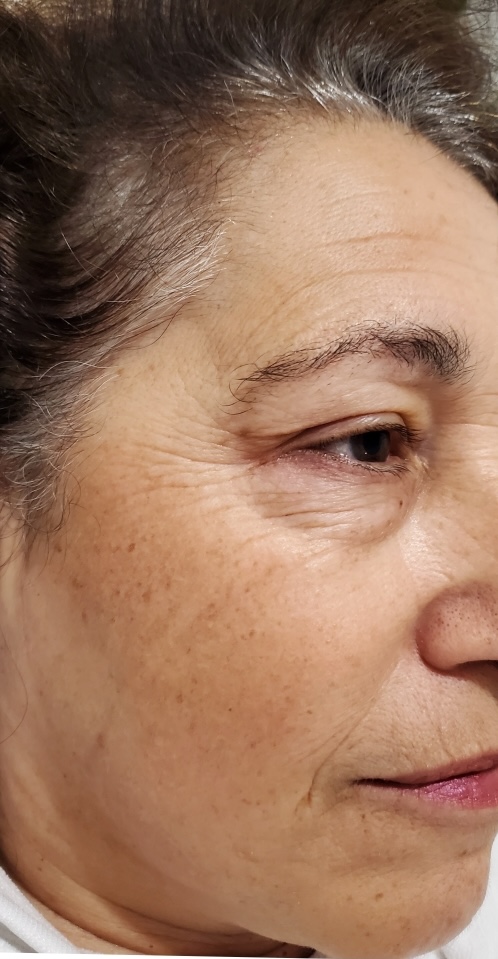 SQT Bio-Microneedling Face before treatment