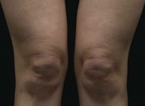 Thermage FLX Knees after treatment