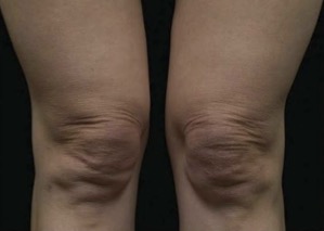 Thermage FLX Knees before treatment
