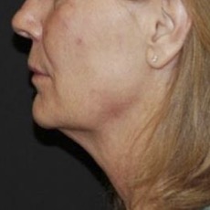 Thermage FLX Face & Neck after treatment