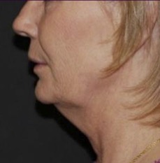 Thermage FLX Face & Neck before treatment