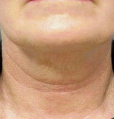 Thermage FLX Jawline and Neck after treatment