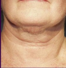 Thermage FLX Jawline and Neck before treatment