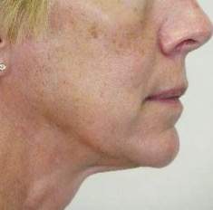 Thermage FLX Jawline and Neck after treatment