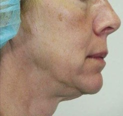 Thermage FLX Jawline and Neck before treatment
