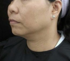 Thermage FLX Jawline and Neck after treatment