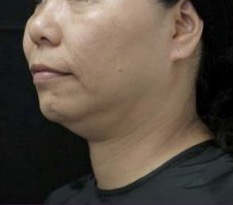Thermage FLX Jawline and Neck before treatment