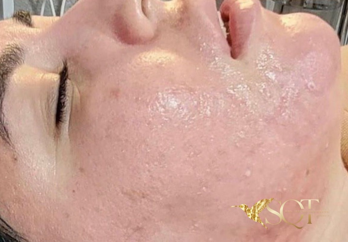 SQT Bio-Microneedling Face after treatment