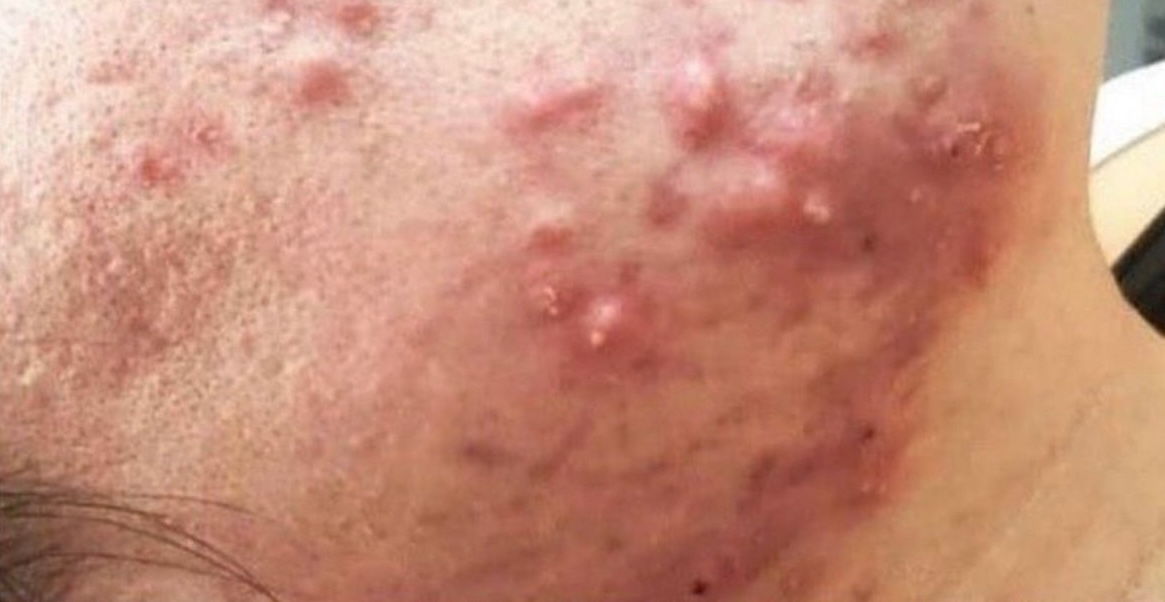 SQT Bio-Microneedling Face before treatment
