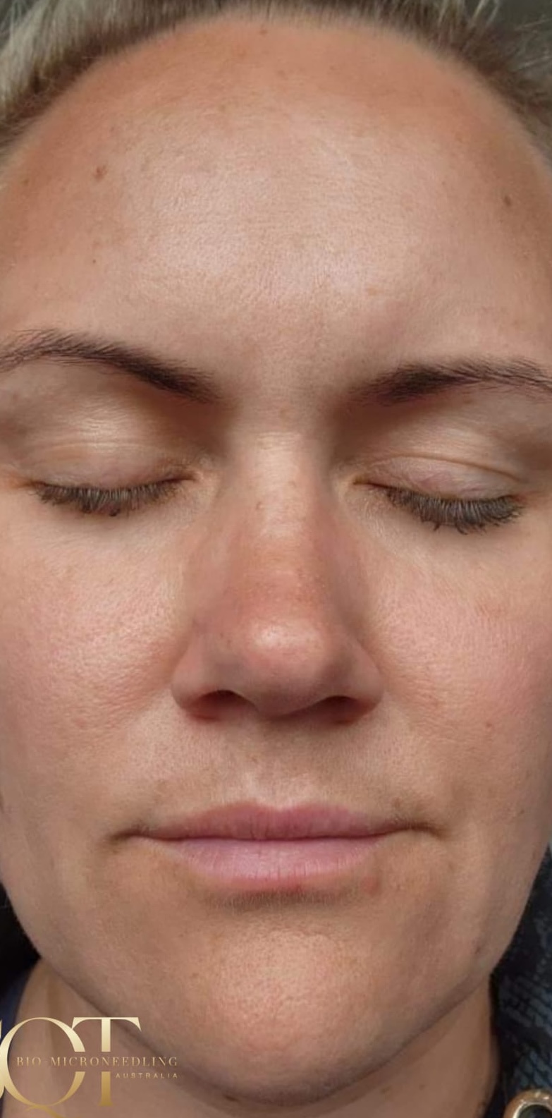 SQT Bio-Microneedling Face after treatment