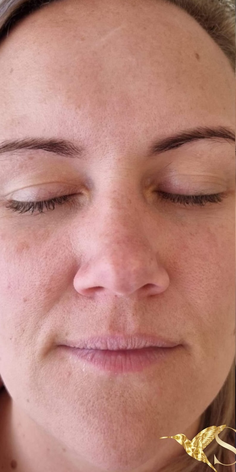 SQT Bio-Microneedling Face before treatment