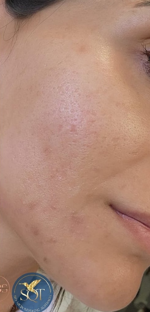 SQT Bio-Microneedling Face after treatment