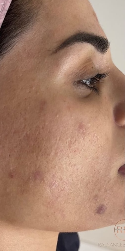 SQT Bio-Microneedling Face before treatment