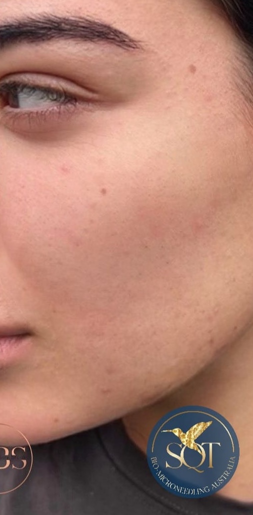 SQT Bio-Microneedling Face after treatment