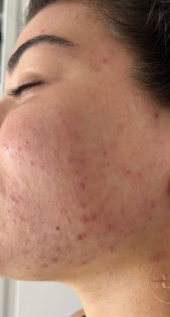 SQT Bio-Microneedling Face before treatment