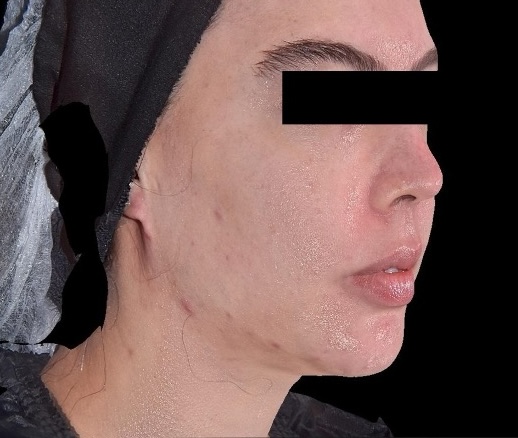 Hifu Ultraformer MPT Full Face, Chin and Neck after treatment
