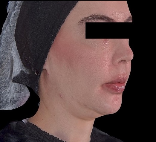 Hifu Ultraformer MPT Full Face, Chin and Neck before treatment