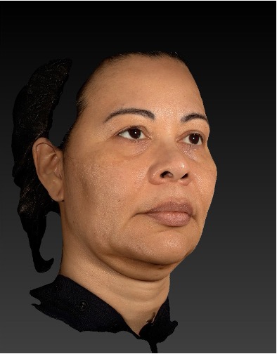 Hifu Ultraformer MPT Full Face, Chin and Neck before treatment