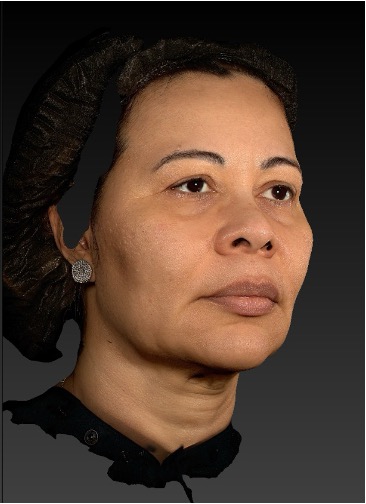 Hifu Ultraformer MPT Full Face, Chin and Neck after treatment